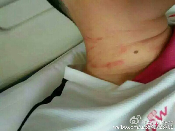 微博网友@王淄铕ziyoo 发布的席老师受伤照片。