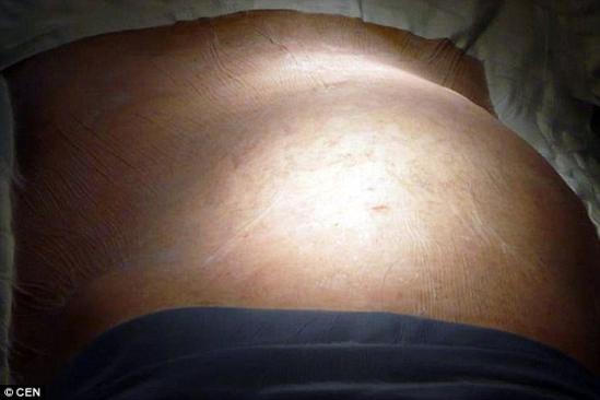 邮报》6月28日报道,近期,一名59岁的俄罗斯男子因肚子肿胀去拜访医生