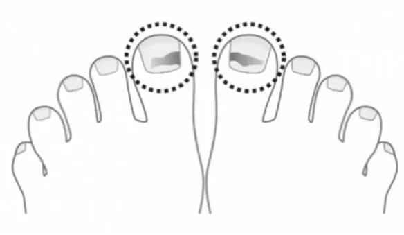跑步造成黑指甲成因和防护措施 要保持干净干