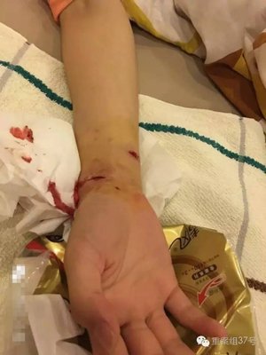 李玲玲在网帖中配图显示，她的手被狗咬的都是血。 受访者供图
