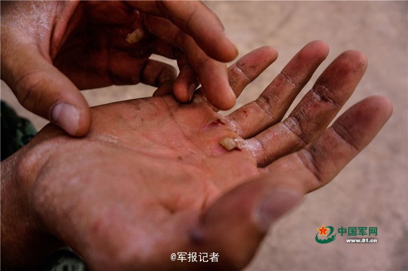 我是做工地的手上老是起茧又褪皮手也很干燥的.都不像