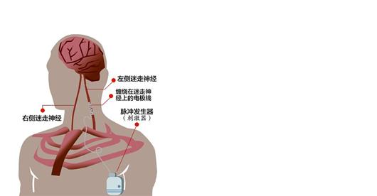 今后,这个刺激器将持续放电,刺激小军的迷走神经,借此抑制大脑的异常