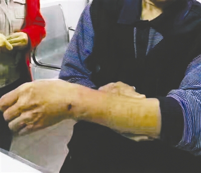 一名市民的手背被咬伤