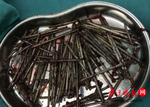 图为从患者胃里掏出的铁钉。病院供图