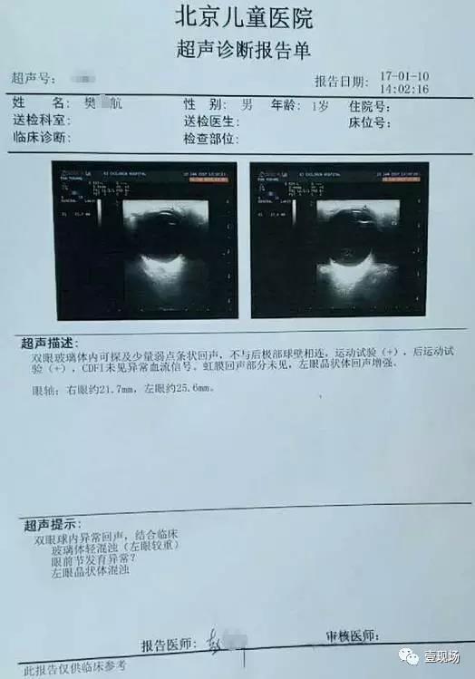北京儿童医院超声诊断报告单显示：航航双眼球内异常回声，结合临床玻璃体轻混浊（左眼较重）等。