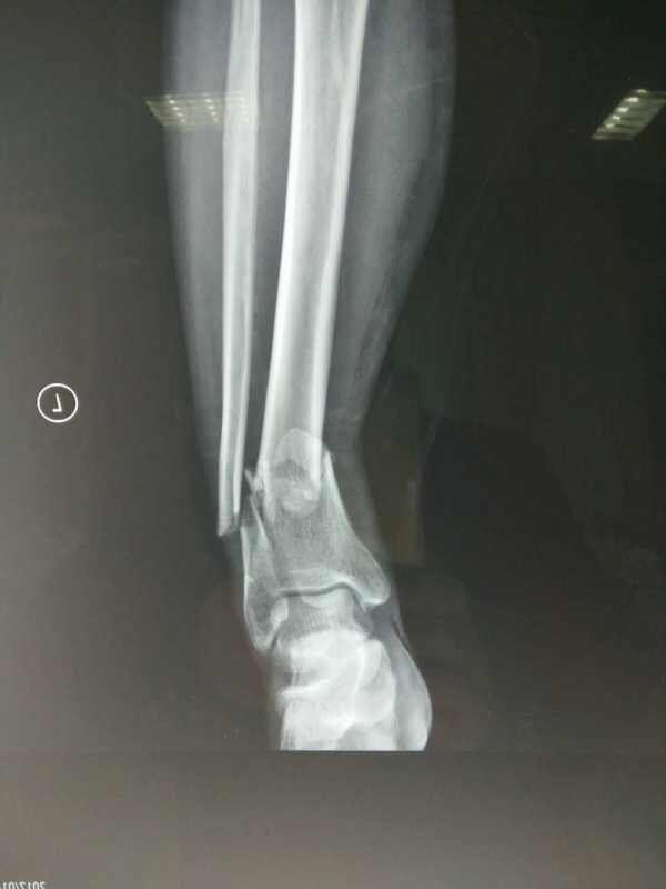 x片显示，靳淑海被撞后，小腿出现严重骨折。