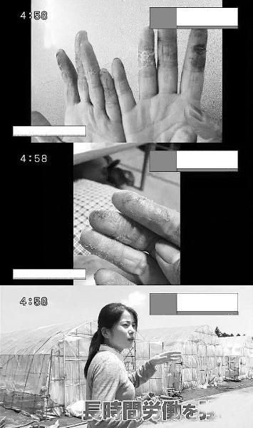 研修生在日本渔业、农业和建筑行业从事低薪、脏、累工作.图为研修生伤痕累累的手（视频截图）