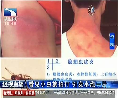 武汉市第一医院皮肤科医师赵芬介绍,最近在皮肤科门诊,她一天能接诊到三四名隐翅虫皮炎的患者,不少都像刘小姐是睡觉起床后发现。