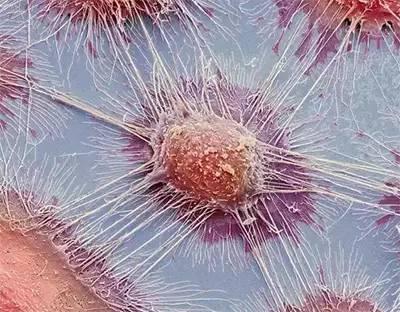 癌细胞为什么会转移?