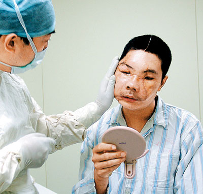 李国兴换脸手术全过程图片