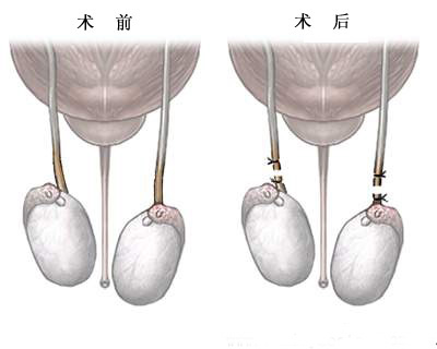 你知道嗎:輸精管結紮術 - 紫南計生 - 紫南家園社區樓梓莊村委會計劃