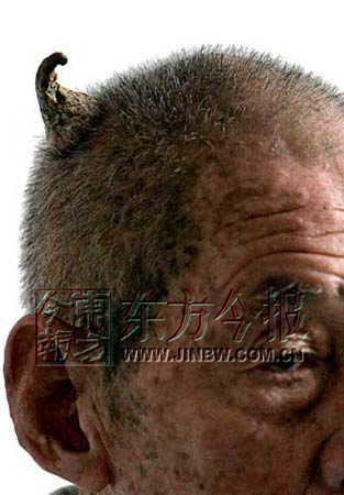 88岁郑州老人头上长出犄角 角长5厘米(图)