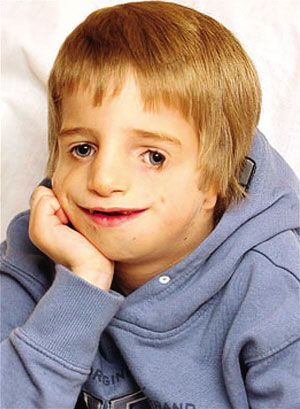英男孩患怪病面部塌陷医院为其做20次手术图