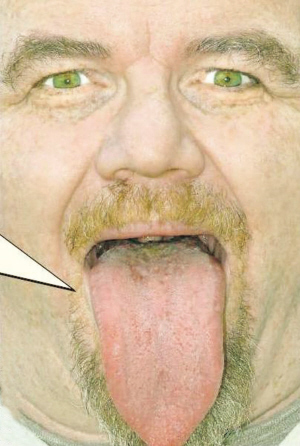 舌头根部长了肉粒图片