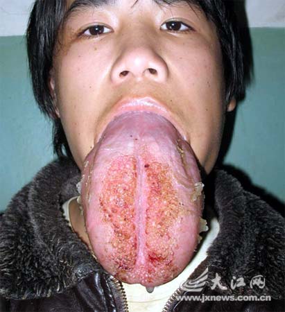 重庆巨舌男孩接受手术其舌疑为世界上最长图