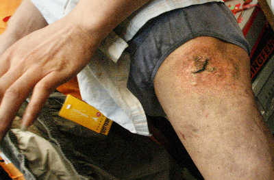 2007年6月1日,钱江小商品市场一摊主手机爆炸伤了大腿