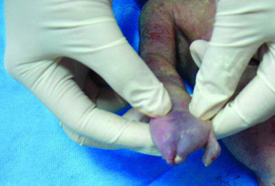 孕妇怀孕前后三次搬家 医院引产产下畸形儿(图)