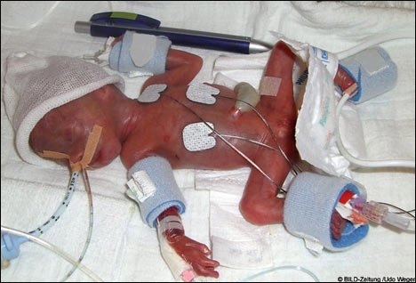 德最小和最早产婴儿出院 出生时仅手机大(组图)