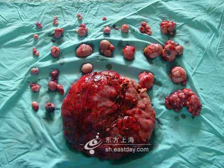 小伙肚内长42斤肿瘤如孕妇 手术4小时康复(图)