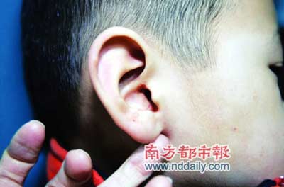 男童考试提前站起被老师揪耳朵 致耳道破裂(图)