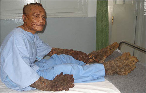 印度树人 手术图片