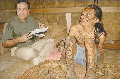 印尼树人 手术 皮肤病图片