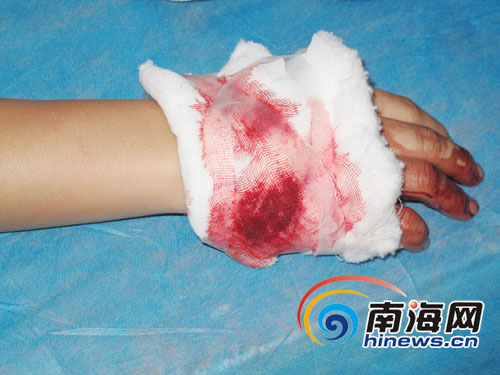 女服务员受伤的右手掌 (南海网记者 陈望摄)