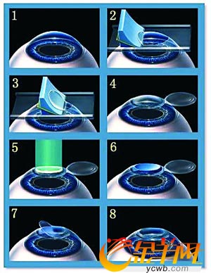 分子激光切削角膜中央前表面,改变角膜前表面弯曲度,调整角膜的屈光力