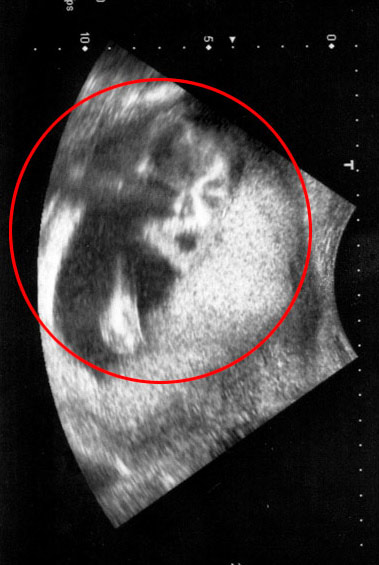 怀孕三个月b超照片图片