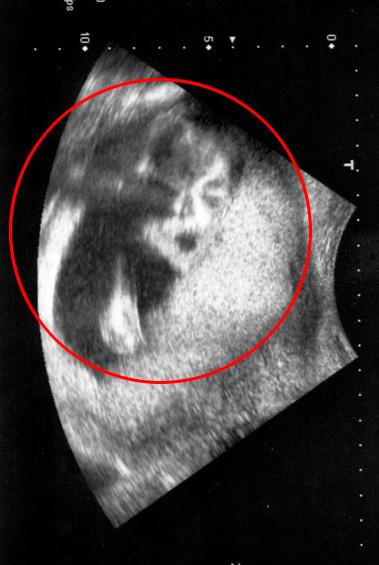 孕妇做胎儿检查 b超照片现歌王杰克逊影像(图)