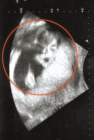 怀孕b超照图片
