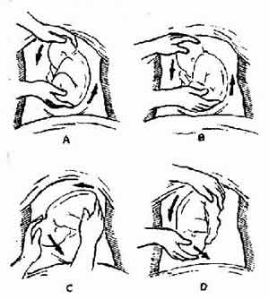 分娩小心四种危险胎位(图)