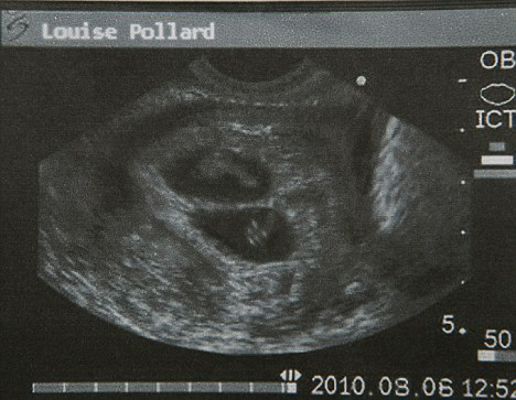 早孕双胎b超图片高清图片