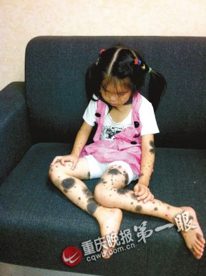 五岁女孩两三年里满身长痣需实施数次手术图