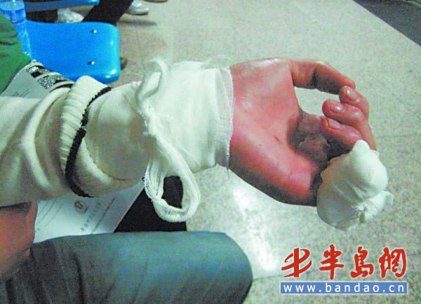 手术过后,侯清受伤的手腕和手指缠着厚厚的纱布