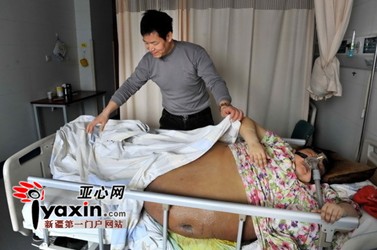 由于体重太重,长期卧床,杨丽娟身上有大面积褥疮
