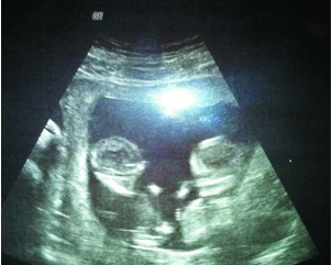 怀孕三个月男孩b超图图片