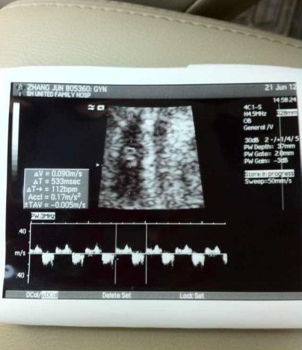 孕14周B超图片