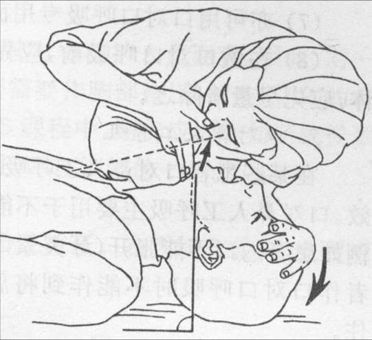 4,开放气道,可用仰头抬颌法开放气道:实施抢救者将一手置于患者前额