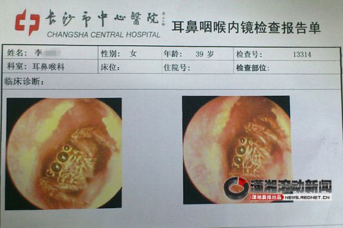 女子耳道藏活蜘蛛 醫院檢查看見實物被嚇哭(圖)