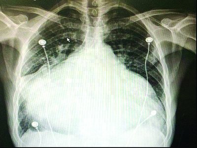男子心脏太大被取出做手术手术时停跳4余小时图