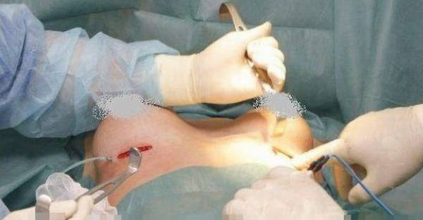 隆胸手术前后图片消毒图片