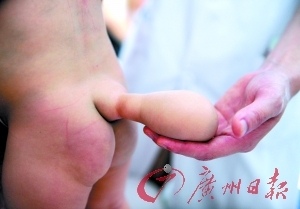 新生儿骶尾部凹陷图片图片