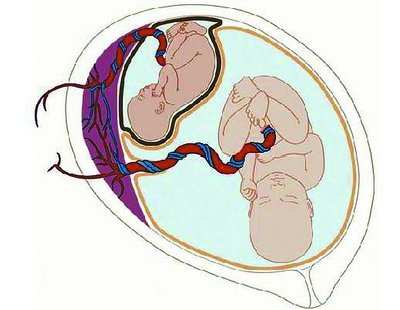 双胎输血综合征示意图