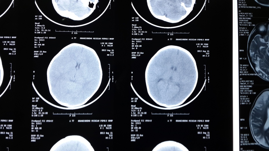 警惕嬰幼兒顱腦損傷後廣泛腦梗塞_手機搜狐網