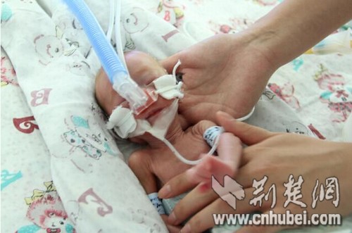 29岁年轻妈妈产下750克男婴 获好心人捐32万救命款_荆楚网