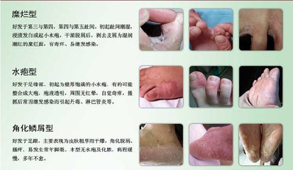 脚趾湿疹与脚气区别图图片