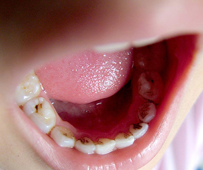牙龈出现红色血点图片