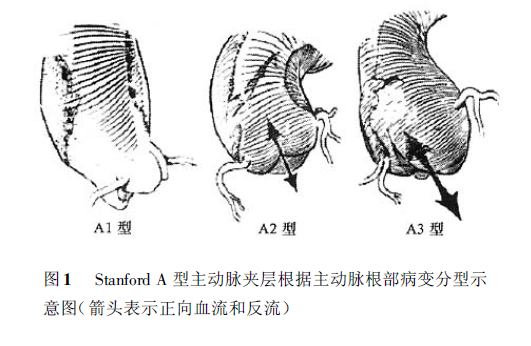 stanford分型图片