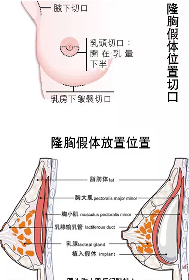 隆胸假体切口一般选在 腋窝,乳房下皱襞,乳晕 三个位置